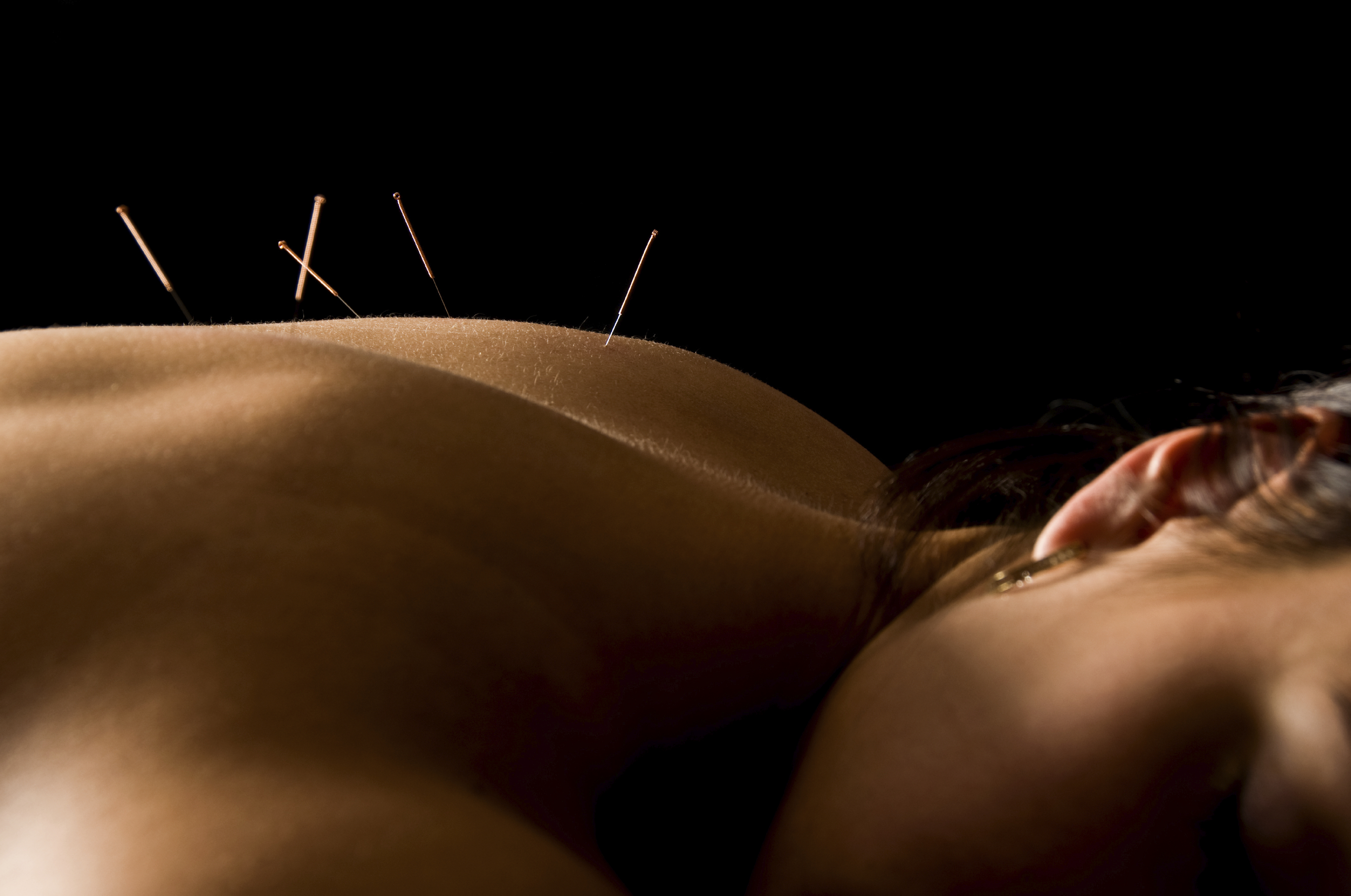 Acupuncture | Comprehensive Pain Management Center
