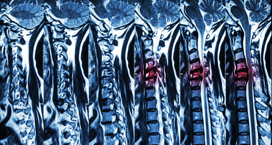 Herniated Disc | Comprehensive Pain Management Center