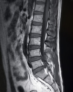 Lumbar Epidural Steroid Injection | ComprehensivePainManagementCenter.com