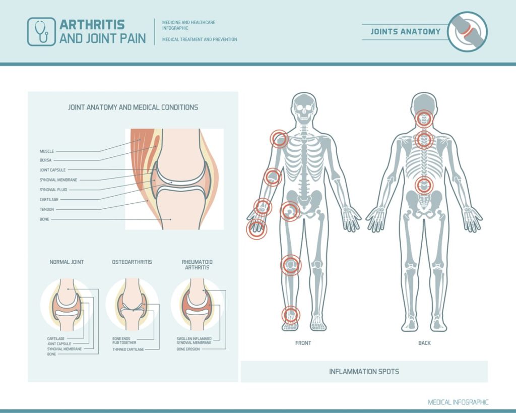 Different Types of Arthritis | Comprehensive Pain Management Center