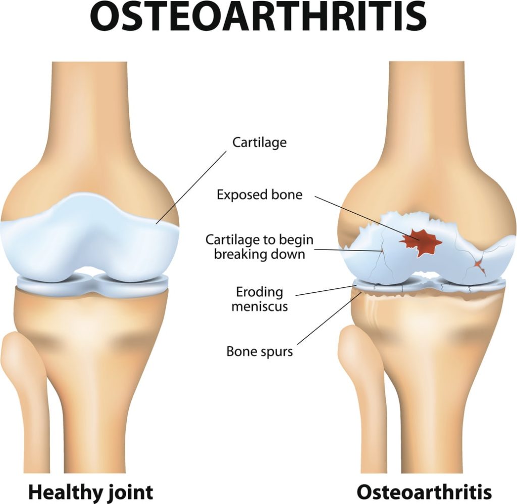 Osteoarthritis Pain | Comprehensive Pain Management Center