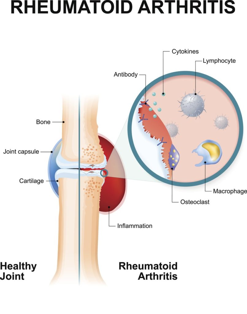 Rheumatoid Arthritis | Comprehensive Pain Management Center
