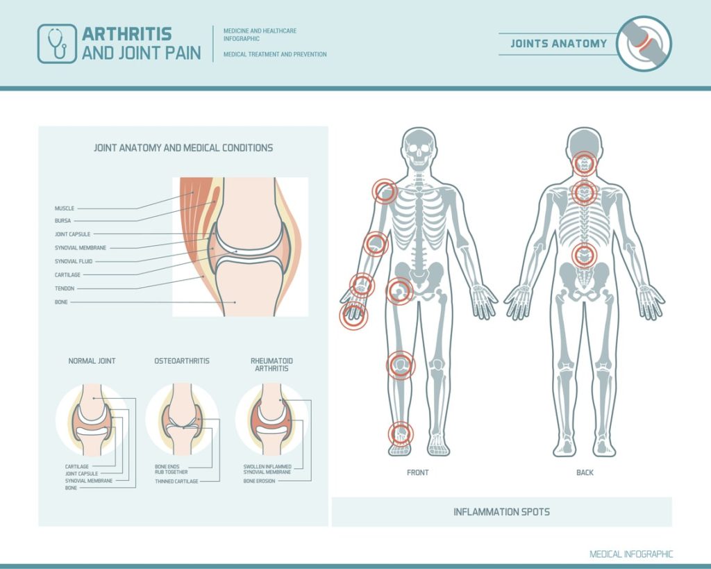 Different Types of Arthritis - Comprehensive Pain Management Center