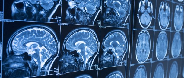 What Happens to the Brain When You Have Chronic Pain?